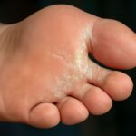 Understanding holes in skin disease and what causes small holes in skin