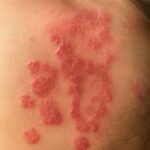 Skin rash on neck and blackheads inner thigh
