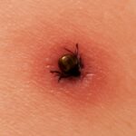 Understanding black dot on skin and black specks coming out of skin