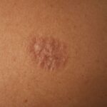 Orange peel skin and orange peel texture skin