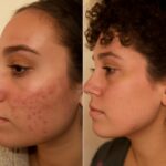 Microneedling for acne and calendula for acne treatments