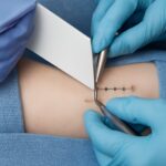 Skin staples and foot skin conditions