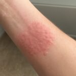 carpet beetle skin reaction, switch skin care