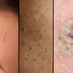 How to neutralize acid on skin and remove tiny shards of glass safely
