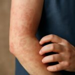 Hives on skin and itchy welts on skin