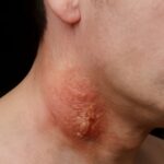 Boil on skin and what causes boils on the skin