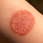Skin fungus and fungal skin rash appearance