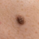 Barnacles on skin and raised brown spots
