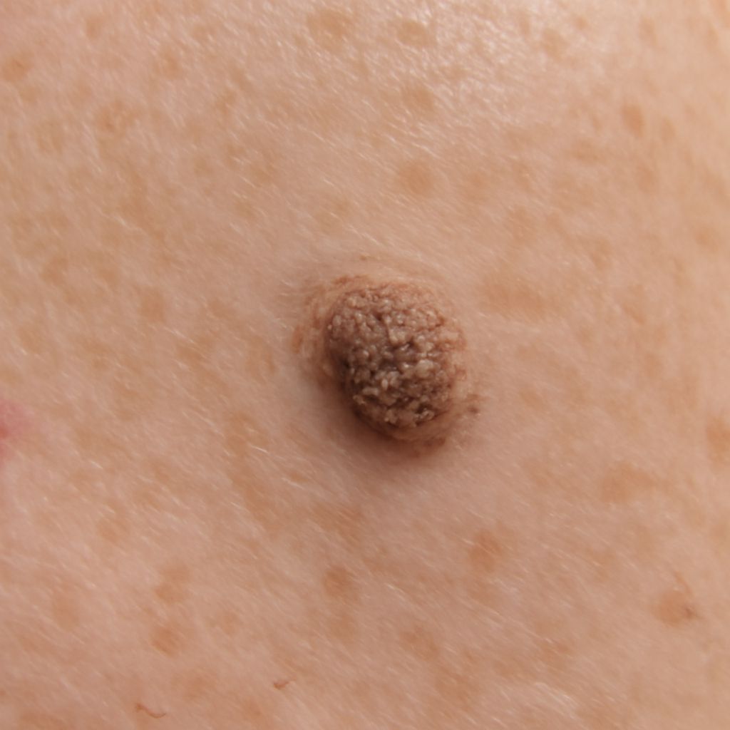Barnacles on Skin: Understanding Common Skin Growths