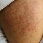 Red spots on skin not itchy and tiny red dots on skin