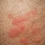 Yeast infection on skin with candida skin symptoms